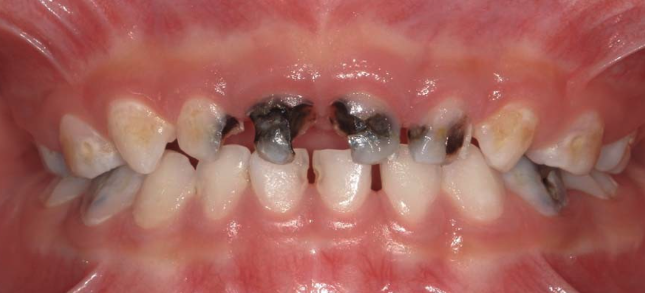 Clinical photo of a young child's primary teeth with advanced decay on the front teeth